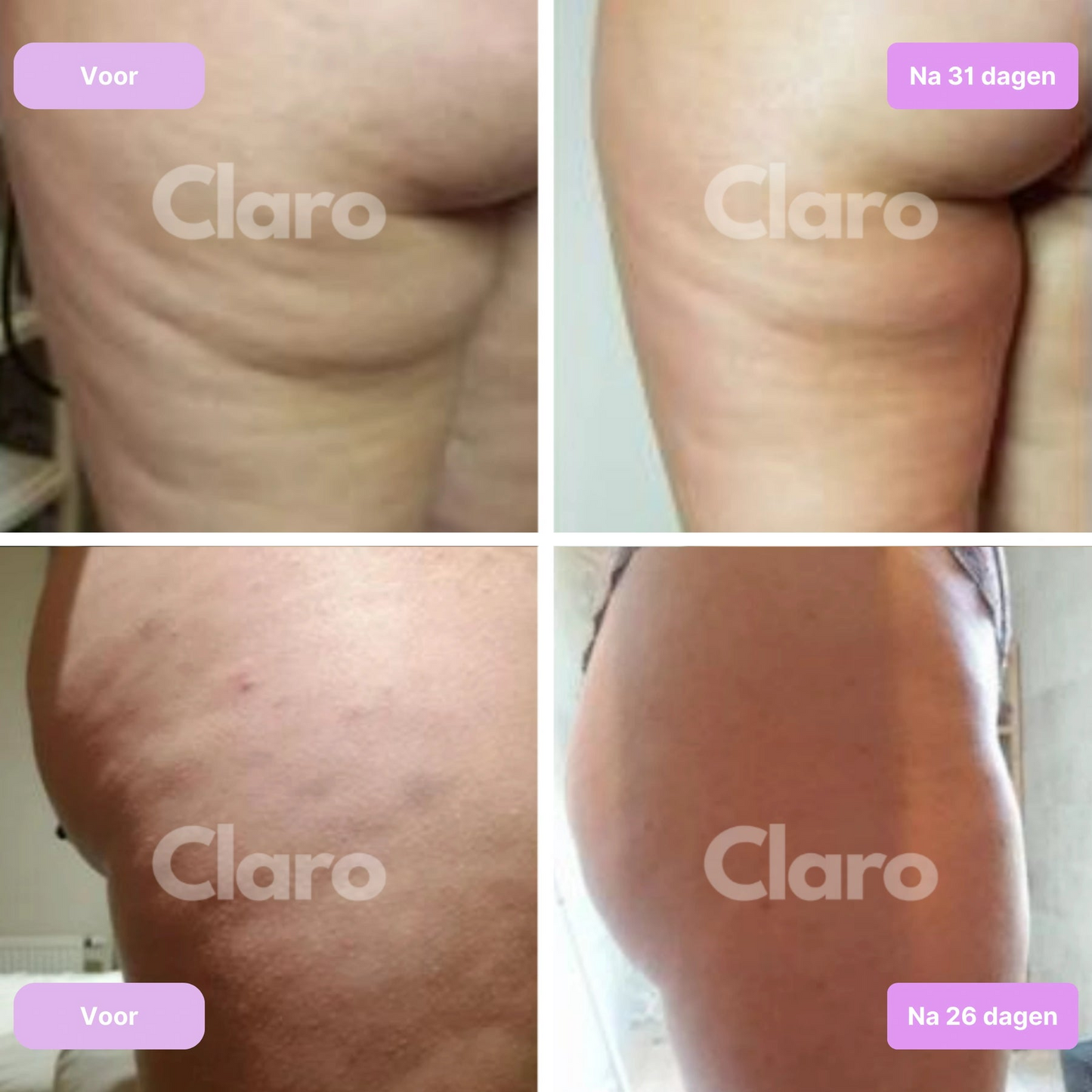 Anti-Cellulite Bundel - Stimuleer Jouw Bloedsomloop